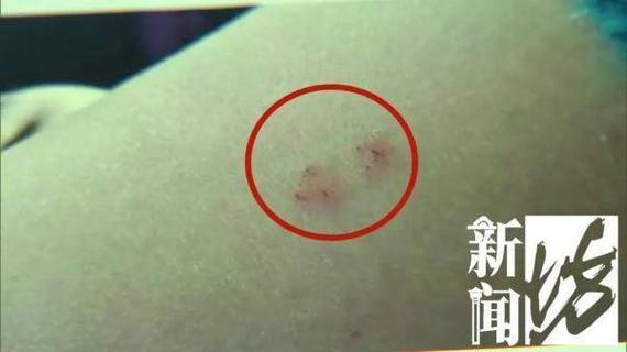 新澳门彩最快开奖记录和被蛇咬反抓蛇再遭咬与被蛇咬反抓蛇再遭咬伤